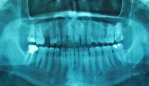 bilan dentaire implantologie